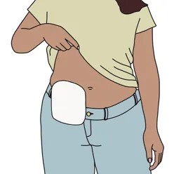 En person løfter t-skjorta og viser fram magen med stomipose, illustrasjon