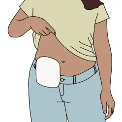 En person løfter t-skjorta og viser fram magen med stomipose, illustrasjon