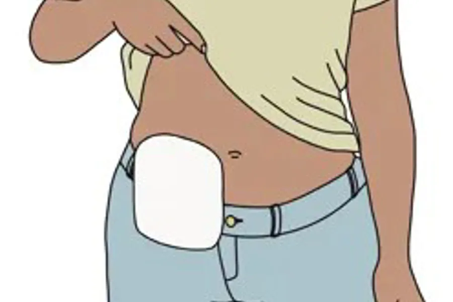 En person løfter t-skjorta og viser fram magen med stomipose, illustrasjon